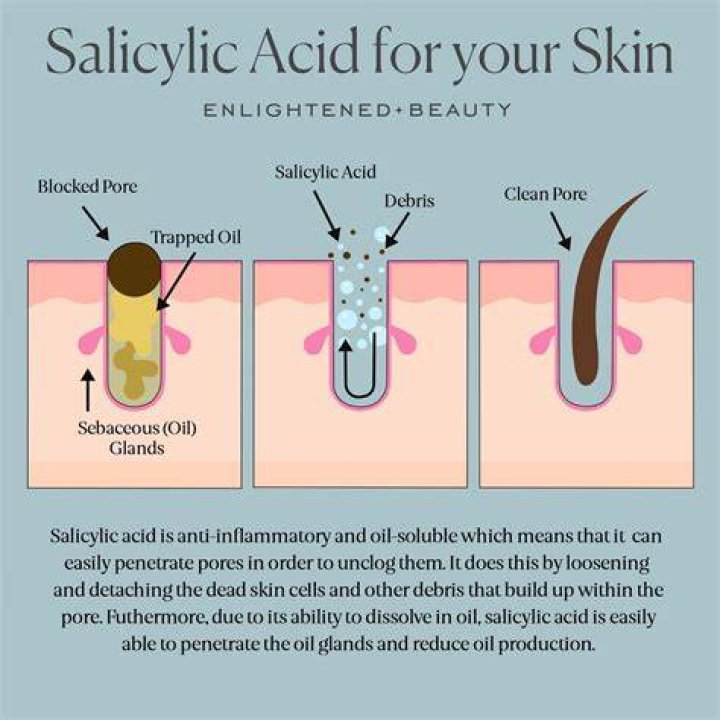 acne benzoyl peroxide salicylic acid